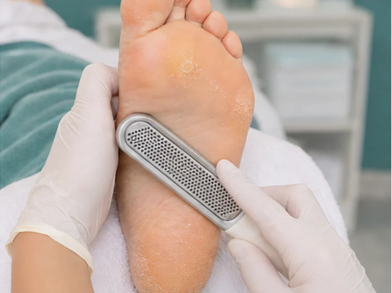 Pedicure verwijdert overtollig eelt onder de voet