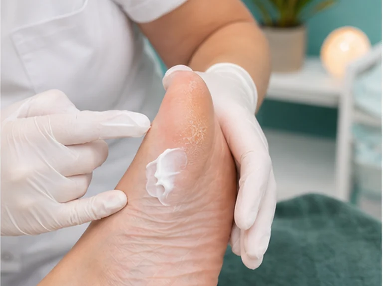 Pedicure verzorgt droge hielen en milde hielkloven