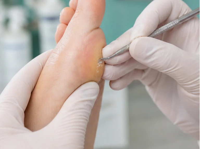 Pedicure verwijdert een kleine likdoorn of eeltpit met schoon instrument