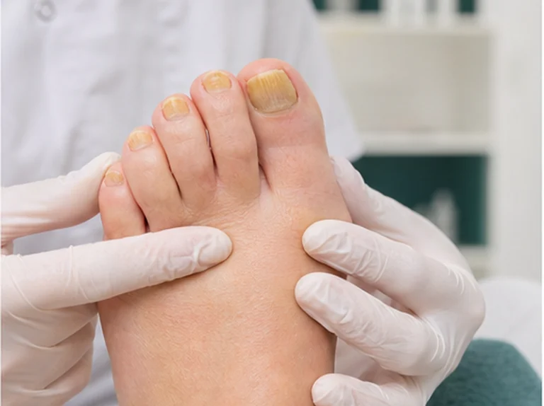 Pedicure behandeling van verdikte kalknagels
