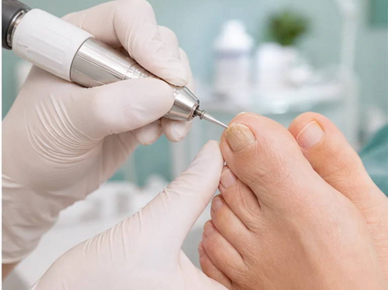 Pedicure verzorgt een verdikte of verkleurde teennagel