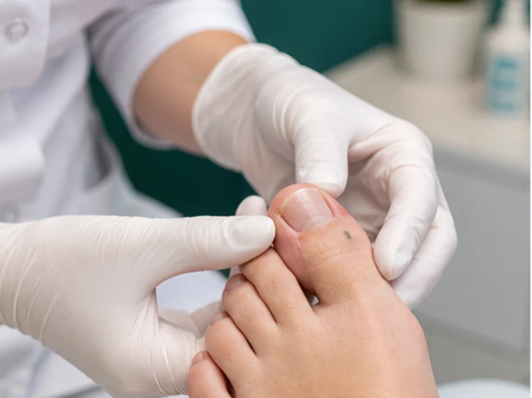 Pedicure onderzoekt kromme teennagel voor nagelbeugel