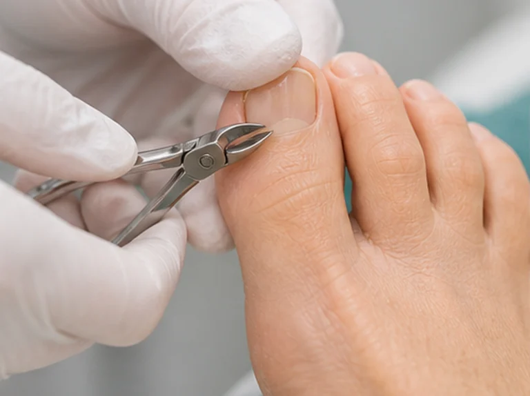 Nagelzorg bij reumatische voeten